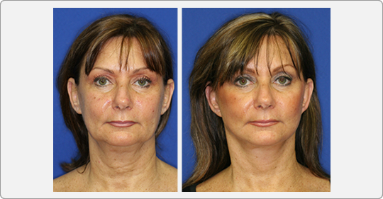 face lift patient
