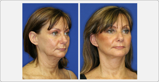 face lift patient