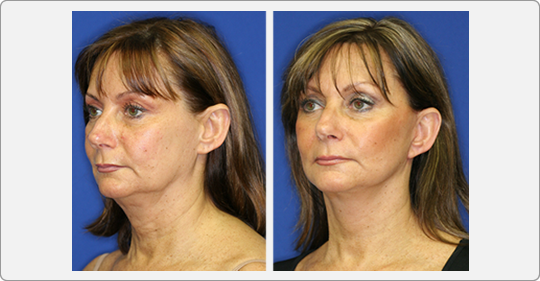 face lift patient