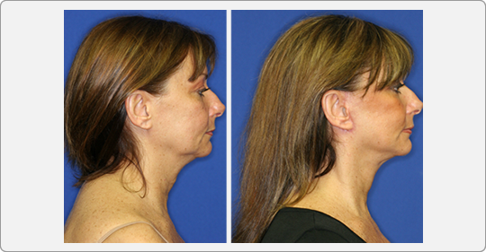 face lift patient