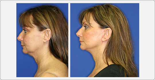 face lift patient
